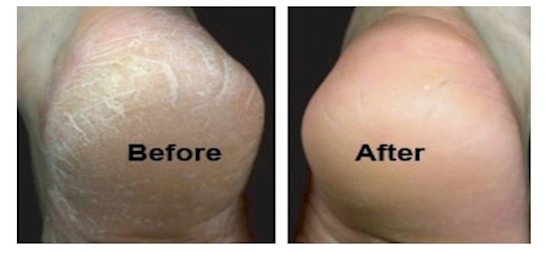 11 Surprising Ways VapoRub Can Cure What Ails You _ cracked heels _ all created